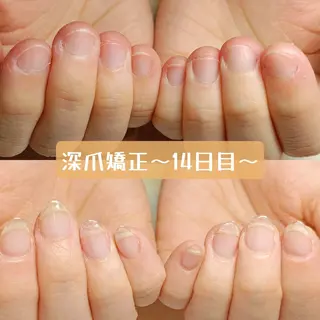 ネイル 深爪矯正/爪育成ケア manie nailのネイルデザイン