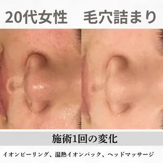 重度ニキビ専門🌷 ダウンタイムなしのエステ・リラクイメージ