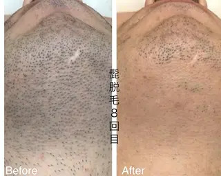 メンズ キッズ 肌管理脱毛ピーリング CDFAkasakaのエステ・リラクイメージ