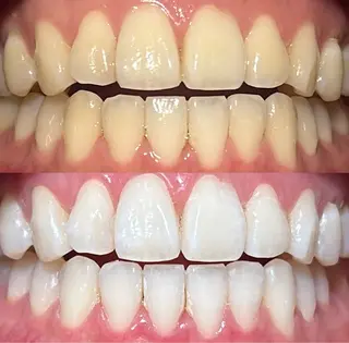 io teeth careのその他イメージ