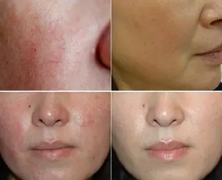 顔脱毛＆毛穴＆ニキビ 優良№1♪ヒロコ♪のエステ・リラクイメージ