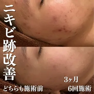 3か月で肌革命👼 ニキビ専門店💫のエステ・リラクイメージ