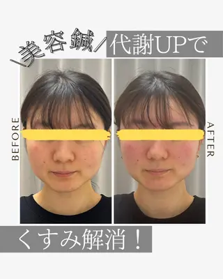 《美肌･小顔》美容鍼 ＆マッサージ＊MEIのエステ・リラクイメージ