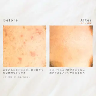 繰り返すニキビ・毛穴 ✨つくば肌質改善専門のエステ・リラクイメージ
