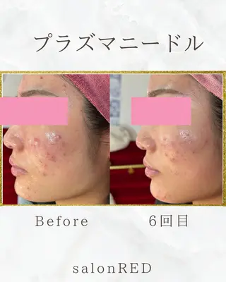 WAX・肌質改善・毛 穴洗浄/林愛真のエステ・リラクイメージ