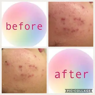 ミディアム ニキビ・肌質改善専門 ♡人生が変わるサロンのエステ・リラクイメージ