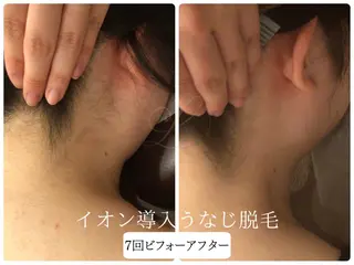 🎀うなじ脱毛🎀 ㅣLino堀江のエステ・リラクイメージ
