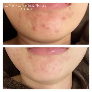 ミディアム カラー パーマ ヘアアレンジ メンズ キッズ ネイル マツエク・マツパ アイブロウ ニキビ跡専門サロン Ainaのエステ・リラクイメージ