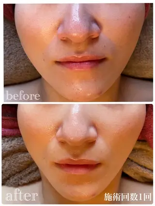 ハーブピーリング 痩身　漢方よもぎ蒸しのエステ・リラクイメージ