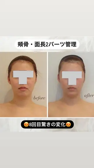 整形級の変化👀 最新✨韓国小顔管理のエステ・リラクイメージ