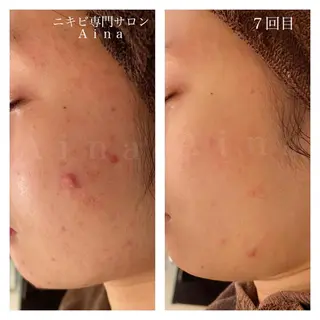 セミロング カラー パーマ ヘアアレンジ メンズ キッズ ネイル マツエク・マツパ ニキビ跡専門サロン Ainaのエステ・リラクイメージ