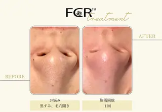 ニキビ改善シャルム ココハーブピーリングのエステ・リラクイメージ