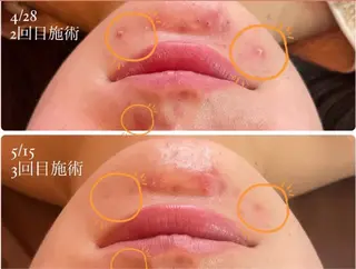 ハーブピーリング Lanaのエステ・リラクイメージ