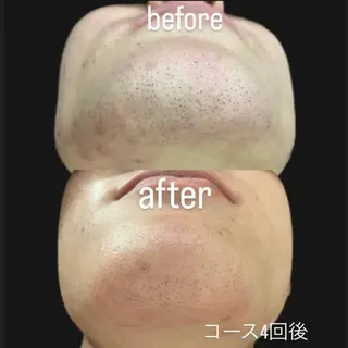 脱毛＆フェイシャル/ Rappore;増田のエステ・リラクイメージ