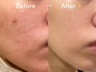 小顔/毛穴/肌質改善 💆セラピエージのエステ・リラクイメージ