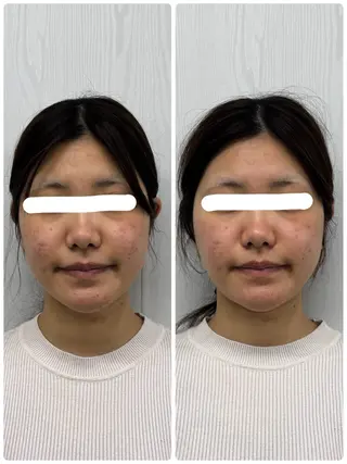 美容鍼×小顔矯正 ×美容整体　浜川泰仁のエステ・リラクイメージ