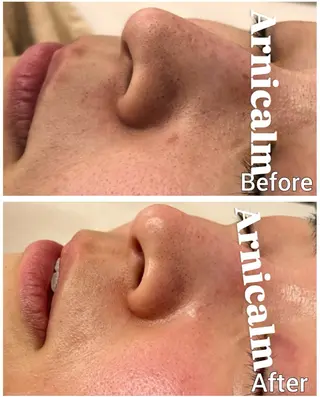 ハーブピーリング 肌再生ピーリング/のエステ・リラクイメージ