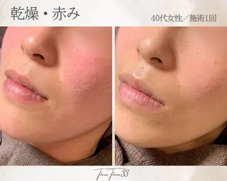 ピーリング×肌管理 THREETHREEのエステ・リラクイメージ