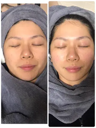 山武•八街 角質オフ フェイシャル🌷ゆかのエステ・リラクイメージ