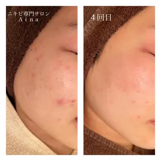 ミディアム カラー パーマ ヘアアレンジ メンズ ネイル マツエク・マツパ ニキビ跡専門サロン Ainaのエステ・リラクイメージ