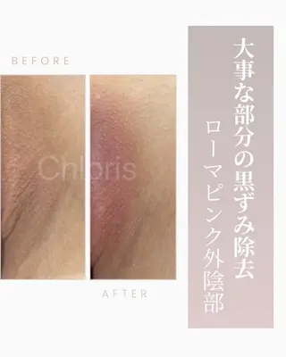 川越デリケートゾーン 光脱毛/ワックス脱毛のエステ・リラクイメージ