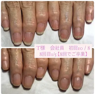 ネイル 自爪育成/深爪矯正 mikiのネイルデザイン