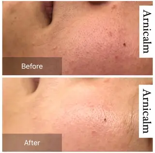 ハーブピーリング 肌再生ピーリング/のエステ・リラクイメージ