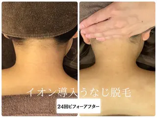 🎀うなじ脱毛🎀 ㅣLino堀江のエステ・リラクイメージ