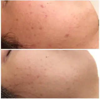 3か月で肌革命👼 ニキビ専門店💫のエステ・リラクイメージ