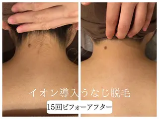 🎀うなじ脱毛🎀 ㅣLino堀江のエステ・リラクイメージ