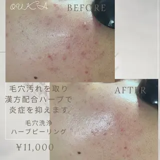 OUKA脱毛 毛穴ケアフェイシャルのエステ・リラクイメージ