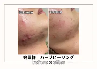 みんなの脱毛 TSURURINのエステ・リラクイメージ