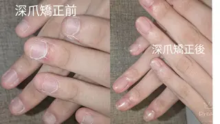 ネイル フィルイン・深爪矯正 長さ出し🎀のネイルデザイン