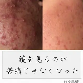 ニキビ経験者が施術 する専門サロン🌻のエステ・リラクイメージ