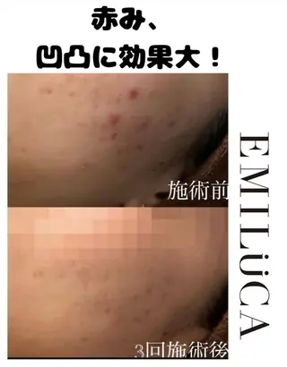 ニキビ・ニキビ跡🌿 ハーブピーリング✨のその他イメージ