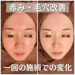 セミロング カラー パーマ ヘアアレンジ メンズ キッズ ネイル マツエク・マツパ アイブロウ 3か月で肌革命👼 ニキビ専門店💫のエステ・リラクイメージ