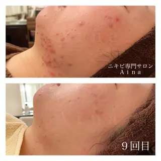 ショート パーマ ヘアアレンジ メンズ キッズ ネイル マツエク・マツパ ニキビ跡専門サロン Ainaのエステ・リラクイメージ