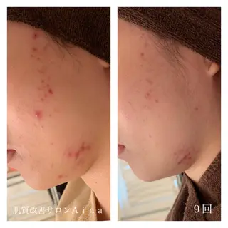 ミディアム カラー パーマ ヘアアレンジ メンズ キッズ ネイル マツエク・マツパ ニキビ跡専門サロン Ainaのエステ・リラクイメージ