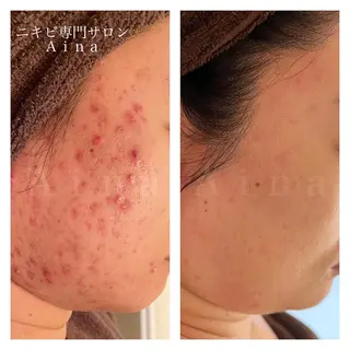 セミロング ヘアアレンジ メンズ キッズ ネイル マツエク・マツパ アイブロウ ニキビ跡専門サロン Ainaのエステ・リラクイメージ