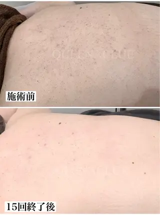 毛穴改善/脱毛 ネイル　川上久仁子のエステ・リラクイメージ