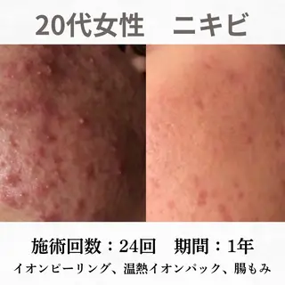 重度ニキビ専門🌷 ダウンタイムなしのエステ・リラクイメージ