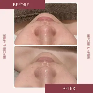 メンズ 頭蓋骨小顔矯正 ハーブピーリングのエステ・リラクイメージ