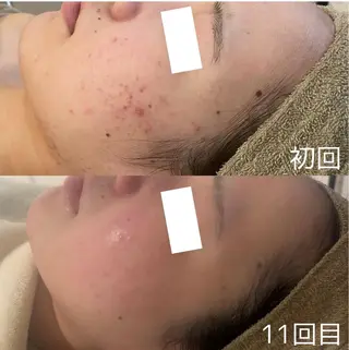 中目黒ハーブピーリン グ🌿ララピールのエステ・リラクイメージ