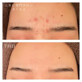 セミロング パーマ ヘアアレンジ メンズ キッズ ネイル マツエク・マツパ ニキビ跡専門サロン Ainaのエステ・リラクイメージ