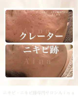 ニキビ跡専門サロン Ａｉｎａのエステ・リラクイメージ