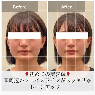 美容鍼/ヘッドスパ/ 💎さかもとのエステ・リラクイメージ