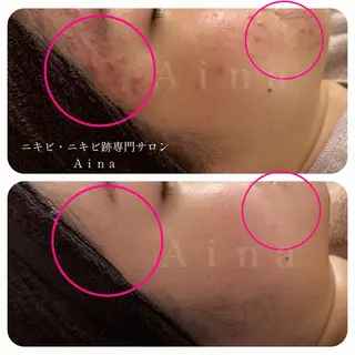 ニキビ跡専門サロン Ａｉｎａのエステ・リラクイメージ