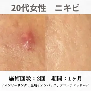 重度ニキビ専門🌷 ダウンタイムなしのエステ・リラクイメージ