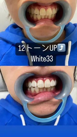 メンズ セルフホワイトニング White33大名のその他イメージ