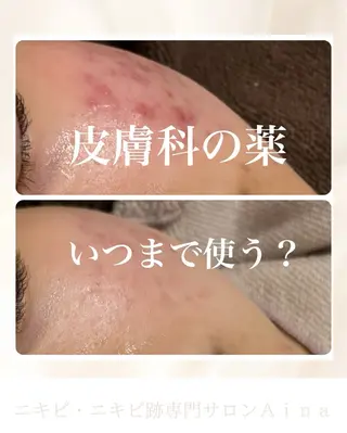 ニキビ跡専門サロン Ａｉｎａのエステ・リラクイメージ